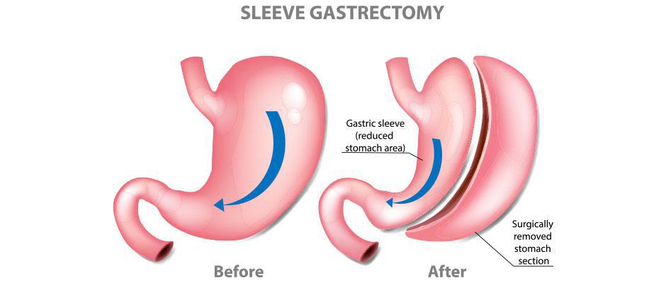 Sleeve Gastrectomy Surgery - Before & After Image